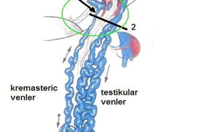 varikosel