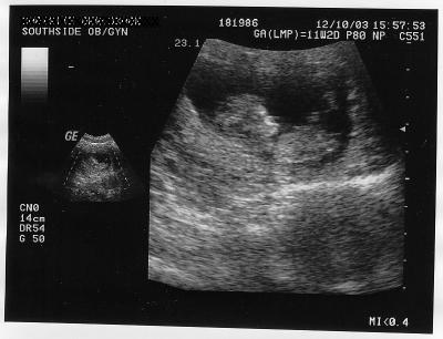 11 haftalık hamilelik