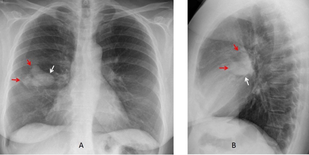 Tüberküloz Röntgeni - Akciğer