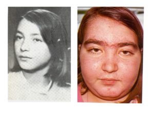 Cushing Hastalığı