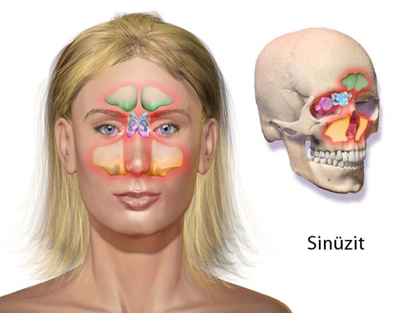sinüzit