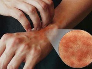 cilt tutulumu, allerji