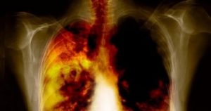 Obstrüktif Akciğer Hastalıkları