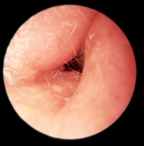 otitis externa