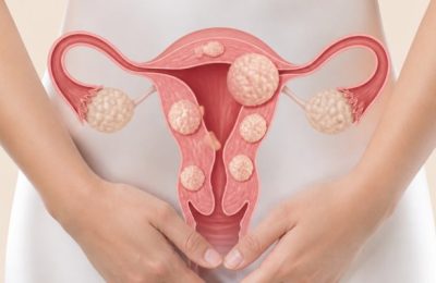 Myomlar Vücudunuzda Sessizce Büyürken Hangi Sinyalleri Verir?