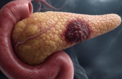 Pankreas Kanseri Vücudunuzda Sessizce Nasıl Bir Fırtına Yaratır