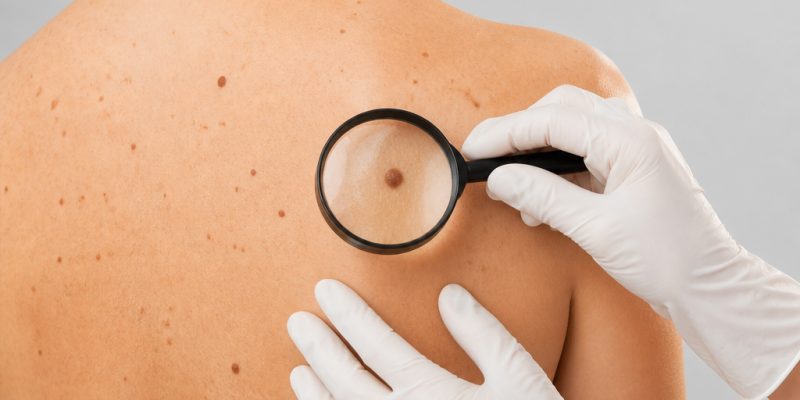 Cildinizdeki Şüpheli Değişiklikler Cilt Kanseri İçin Alarm Veriyor mu