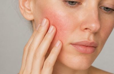 Yüzünüzdeki Kızarıklık Sadece Hassasiyet mi Rosacea Sinsice İlerliyor Olabilir mi?
