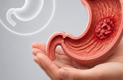 Mide kanseri tehlikesi Vücudunuzdaki gizli sinyalleri yakalamak mümkün mü?