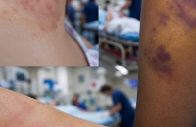 Ani Ortaya Çıkan Cilt Değişimleri Acil Servisin Sinsi Tuzağı
